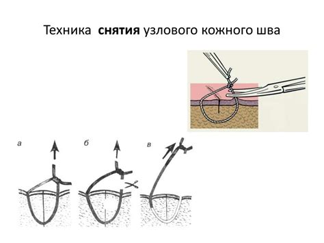 Сроки снятия шва: