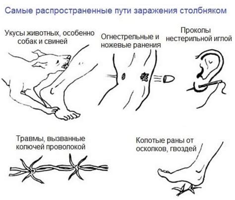 Столбняк: причины быстрого развития