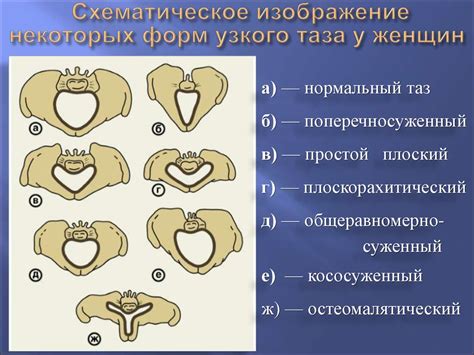 Типы узкого таза у женщин