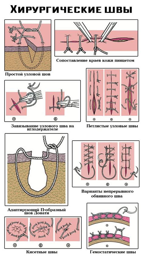 Удаление шва