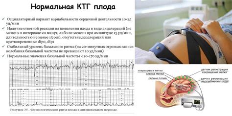 Что такое КТГ?