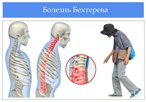 Что такое дорсальные бегунки Бехтерева?