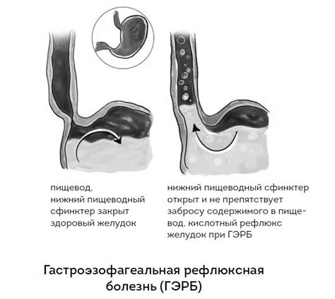 Что такое изжога и почему она возникает?