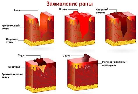 Что такое коллоидный рубец на коже?