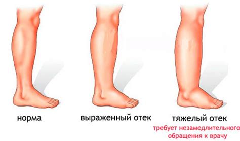 Что такое отеки ног и как они возникают