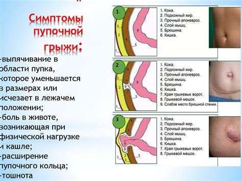 Что такое пупочная грыжа?