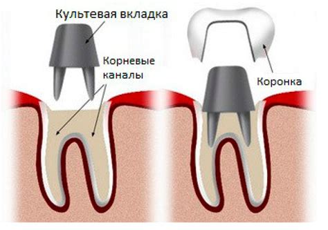 Шаги установки коронки Леорика: