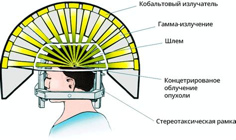 Эффективность гамма ножа Трафальгара Ло